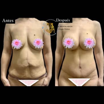 Slider image (3) Dra. Brenda Arcos Vera Cirugia Plastica